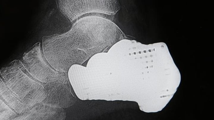 A CT scan of the patient's right foot with the 3D-printed titanium heel implant